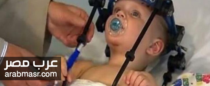 نجاح الاطباء بتثبيت رأس طفل مع عامودي الفقري بعد تعرضه لحادث كبير | شبكة عرب مصر
