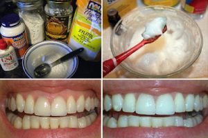 التخلص من اصفرار الاسنان وأعد لأسنانك بياضها وبريقها بفترة قصيرة بهاتين الوصفتين الطبيعيتين