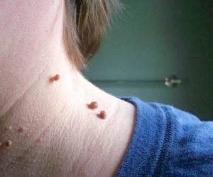 التخلص من العلامات الجلدية البارزة والاثاليل بشكل امن ببعض النصائح الهامه