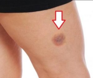 التخلص من الكدمات سريعا وكيفية علاجها بوصفات منزلية تعرف عليها ببعض النصائح