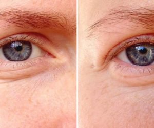 التخلص من تجاعيد العين وعلاجها بطرق بسيطة تعرف عليها الان