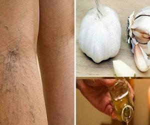 التخلص من الدوالي نهائيا بوصفه منزلية بسيطة جدا تعرف عليها الان