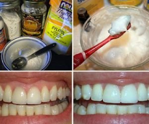 التخلص من اصفرار الاسنان وأعد لأسنانك بياضها وبريقها بفترة قصيرة بهاتين الوصفتين الطبيعيتين