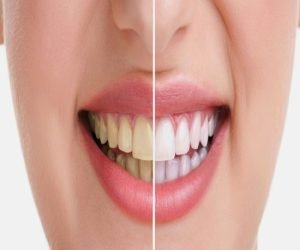تبييض الاسنان بشكل سليم اتبع تلك النصائح لابتسامة رائعة تعرف الان