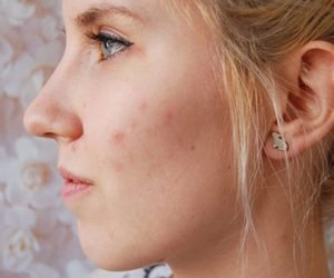 علاج حب الشباب في البشرة والتجنب من ظهورها مره اخري في بشرتك