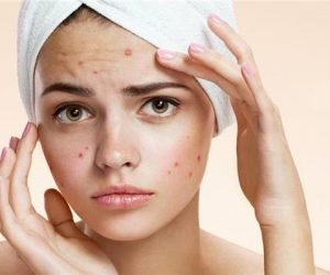 علاج حب الشباب من دراسة تثبت انها تعالج بمدرات البول لدي المرأه